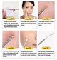 Blackhead Remover Pointed Needle and Blackhead remover Rounded Needle , Acne Remover Needle, Pimple Remover Needle